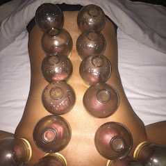 Cupping