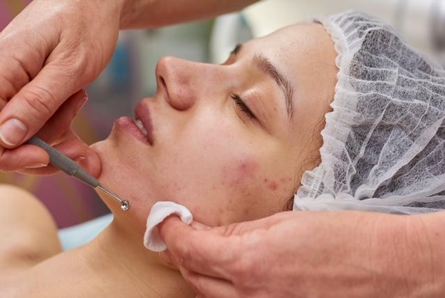 Acne Oily Treatment - Only $80