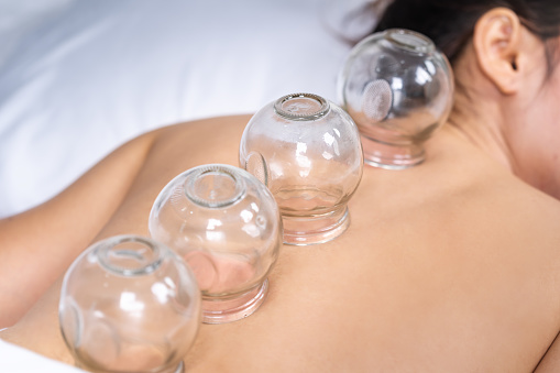 $20 for Cupping Therapy