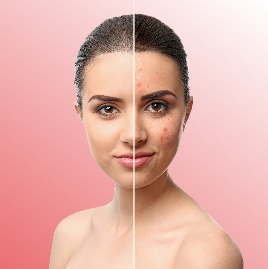 Anti Acne Treatment